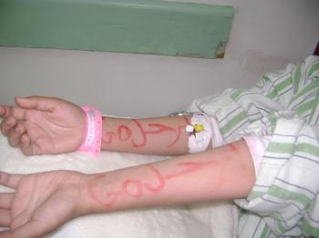  في رصد لاصابة اطفال زج بهم في مظاهرات بالعاصمة : الطفلة شيماء تم خطفها والكتابة على ذراعيها انتقاما من عمها المؤتمري