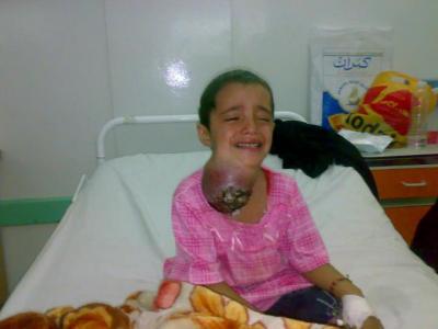 (بالصور) مرض خبيث يخنق طفلة يمنية "قصة مأساوية"